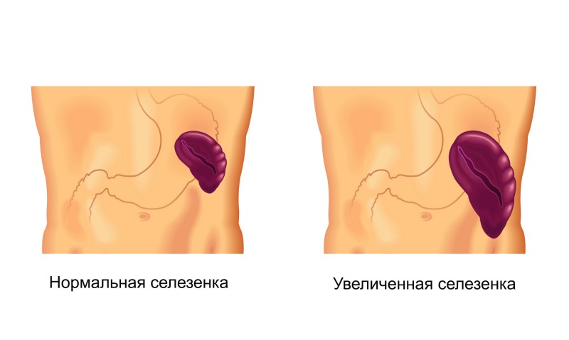 Možné příčiny nepohodlí na levé straně při běhu: